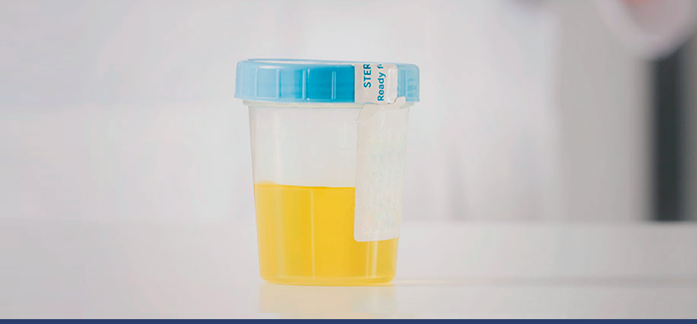 Biomarcadores na urina ajudam a detectar o câncer de próstata